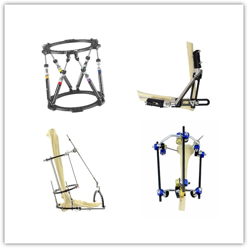 CareFix Combined External Fixator System Component Layout